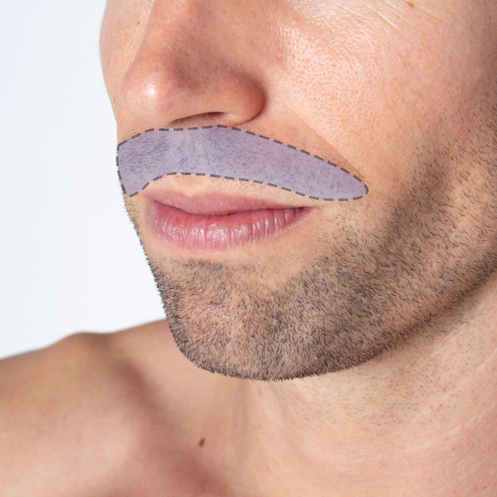 Labio Hombre
